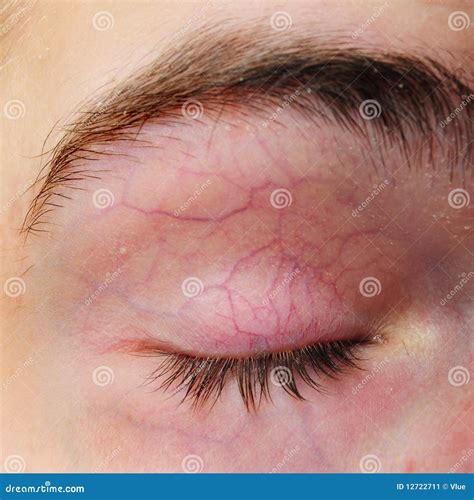 List 98+ Pictures Pictures Of Broken Blood Vessels In The Eye Updated