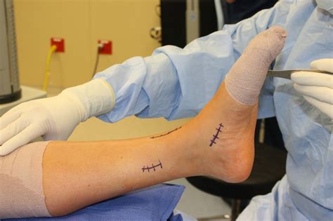 Foot Drop Treatment (Tendon Transfer Surgery) Procedure & Recovery