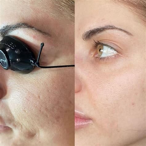 Erbium Laser Resurfacing: All You Need to Know