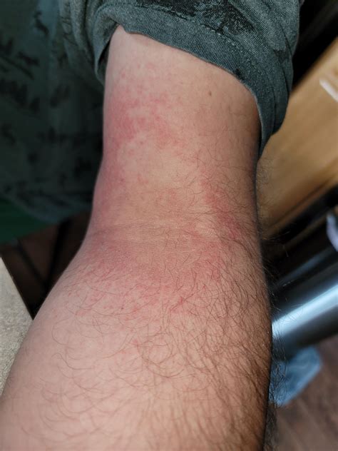 Weird Bumps on throat and scratchy throat after eating peanut butter