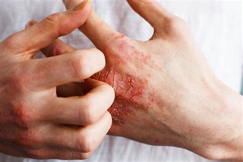 Icotrokinra Outperforms Deucravacitinib in Psoriasis Phase 3 Trials