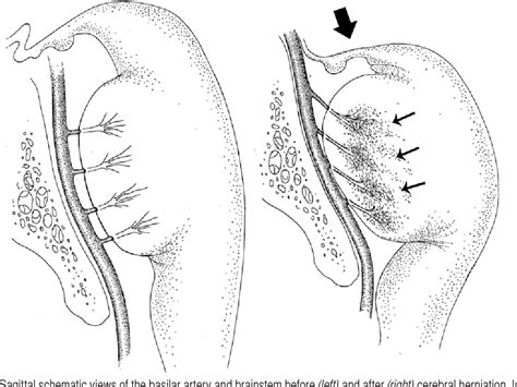 Figure 1 from Survival with good outcome after cerebral herniation and ...