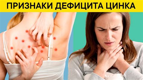 10 Тревожных Признаков Дефицита Цинка. Быстрые способы восполнения ...