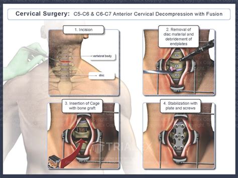 Cervical Surgery: C5-6 & C6-7 Anterior Cervical Decompression with ...