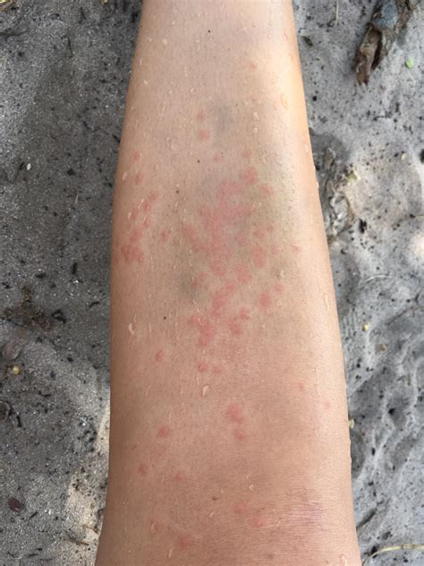 242 best r/allergies images on Pholder | This used to never happen when