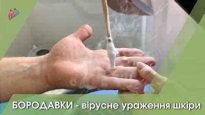 Виды бородавок [66 фотографий]