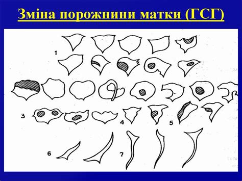 Доброякісні пухлини матки та яєчників. (Лекция 2) - презентация онлайн
