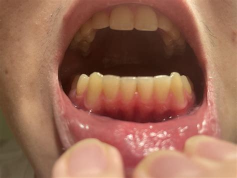 How much are my bottom canine gums recessed? : r/askdentists