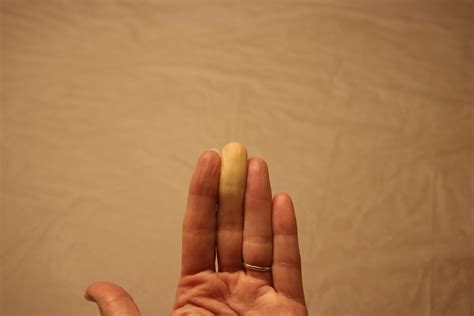 raynauds disease  washington post