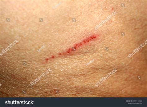 13 Minor Torn Skin Injury Images, Stock Photos, 3D objects, & Vectors ...