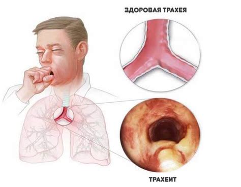 Пропал голос: как лечить в домашних условиях и быстро его восстановить