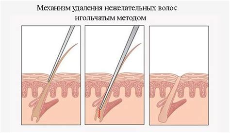 Электроэпиляция: что это такое, виды и методы, противопоказания, цены ...