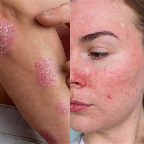 nummular eczema face