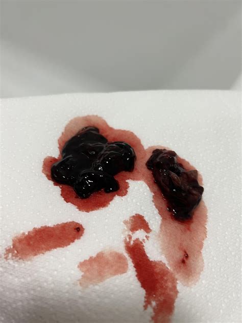 Clots from a medical abortion : r/MedicalGore