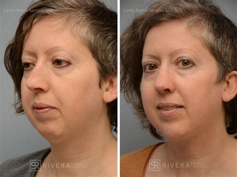 aesthetic nose surgery front  case  dr carlos rivera