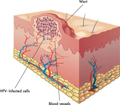 14 Common Warts Hand Stock Vectors and Vector Art | Shutterstock