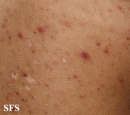 Pityriasis Lichenoides Et Varioliformis Acuta - NC Commons