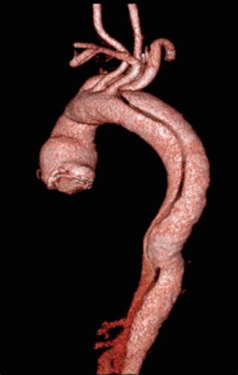Disekcija aorte - Vaskularnahirurgija | vaskularnahirurgija.me