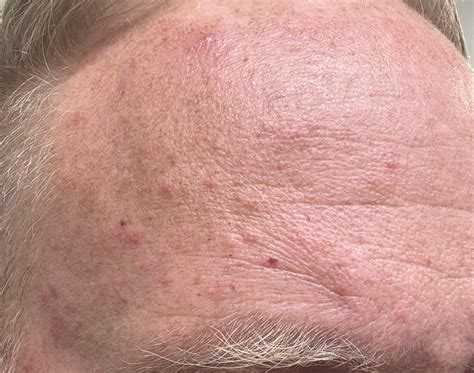 What are these pimple like bumps that I don't think are pimples? : r