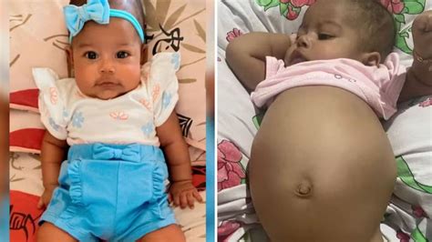Bebê Com Barriga Estufada E Dura - Bebê de 4 meses com suspeita de tumor na barriga luta por tratamento no ...