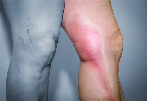 Thrombophlebitis of superficial veins: What is phlebitis and why does ...