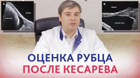 Рубец после кесарева. Ультразвуковая оценка рубца на матке после ...