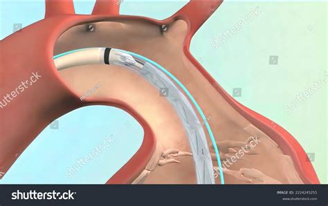 Coronary Stent Implantation Procedure Treatment Acute Stock ...