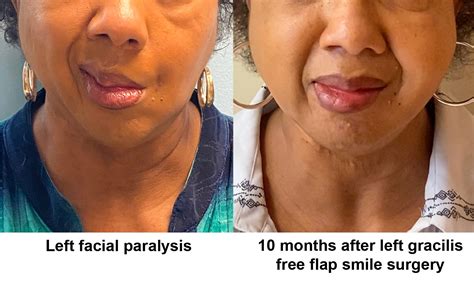 Gracilis Free Flap | UNC Facial Nerve Center
