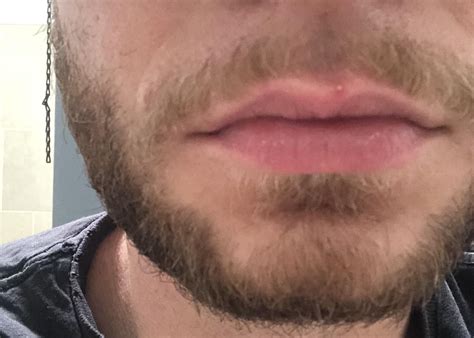 Recurring whitehead on lip line? : r/acne