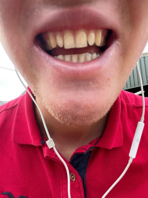 I see this grey spot in-between my teeth , rotten? : r/Teethcare