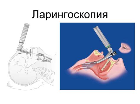 Интубация трахеи - online presentation