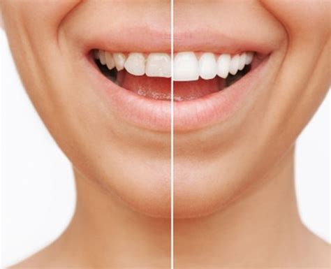 Veneers | Queens, NY | Breezy Point Smiles