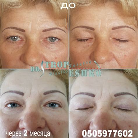 Блефаропластика в Запорожье цена => стоимость пластики век в Днепре ...