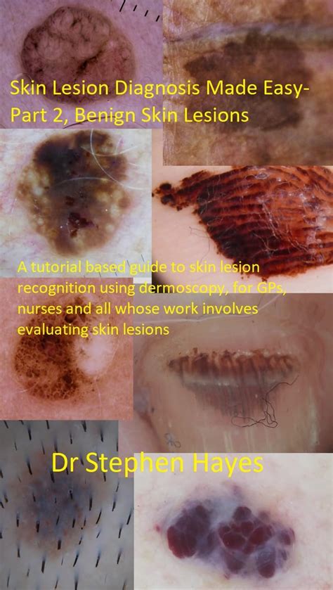 skin lesion diagnosis  easy part  benign skin lesions  tutorial