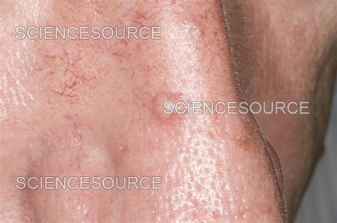 Basal cell carcinoma of the nose | Stock Image - Science Source Images