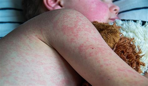 gejala campak  anak kenali tahapan awal hingga ruam khas