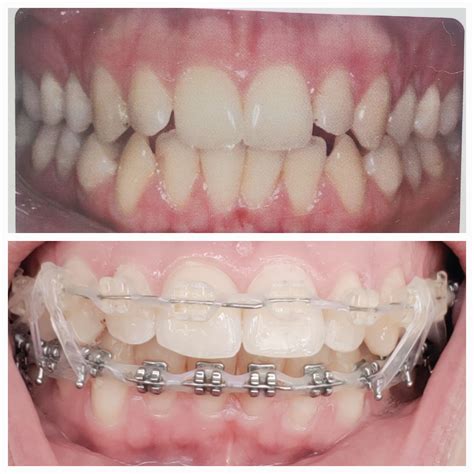 Posterior open bite caused by braces | Scrolller