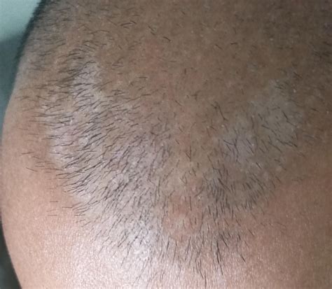 What are these white patches on the scalp? Thanks : r/skin