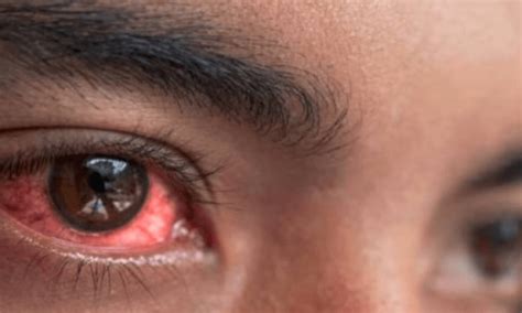 Extra school holidays slow down spread of conjunctivitis - Pakistan ...