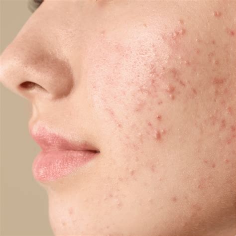 Acne: tipos e cuidados - Dermatologista Dra. Marcela Uehara