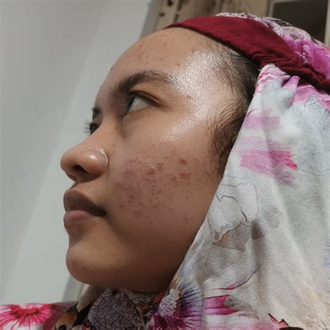 jenis jerawat object detection dataset  pre trained model  bri