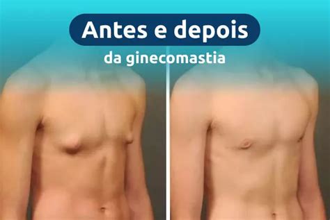 Ginecomastia Antes E Depois
