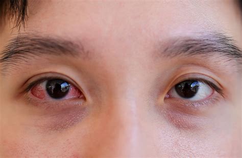 10 Common Eye Diseases: The Signs, Symptoms, & Treatments