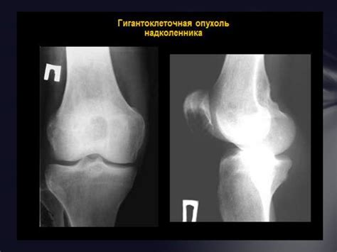 Доброкачественные опухоли костей - презентация онлайн