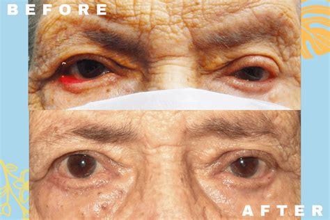 Ectropion Repair Honolulu | Eyelid Surgery Honolulu | Oculoplastics Center