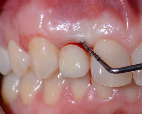 Peri-implantitis: Prevent, Recognize & Treat - ITI Blog