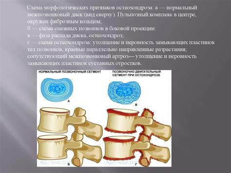 Остеохондроз - презентация онлайн