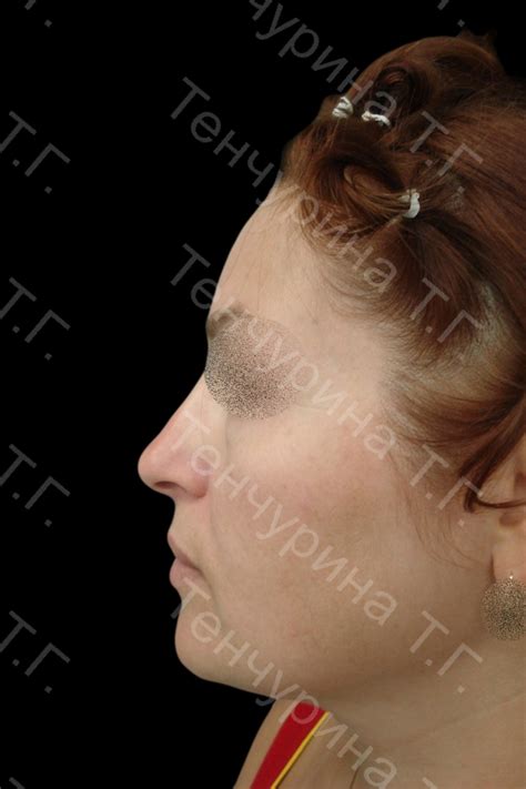 Эндоскопический лифтинг лба - Пластический хирург Тенчурина Татьяна ...