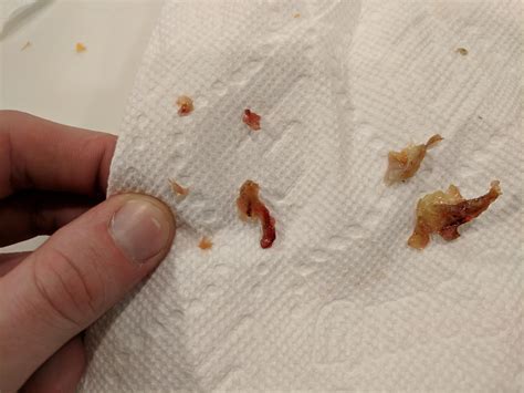 Nasal Polyps Sinus Infection