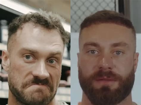 Chris Pratt Hair Transplant | Before and After